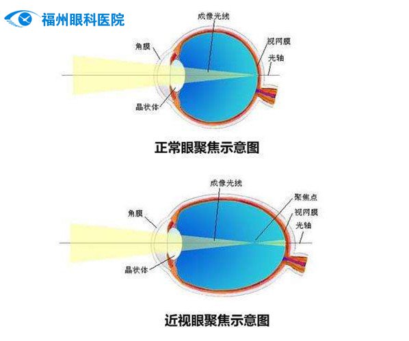 在正常的眼睛上,平行光经过晶状体的折射后,能集合成焦点,成像